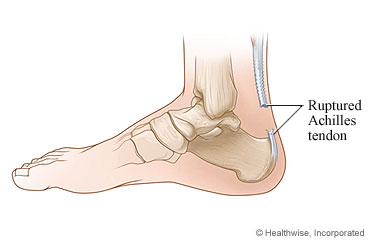 A ruptured Achilles tendon