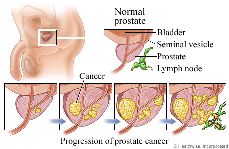 Progression of prostate cancer.