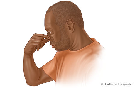 Man pinching his nose to stop a nosebleed.