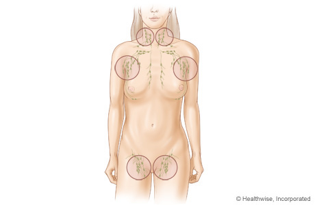 Common sites of swollen lymph nodes