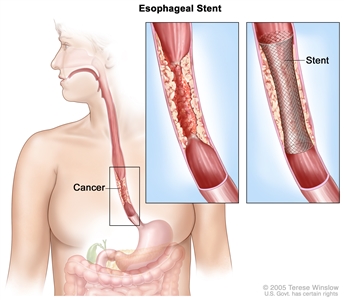 Esophageal stent. Shows cancer blocking esophagus. Insets show enlarged area of cancer and a stent placed in the esophagus to keep it open.