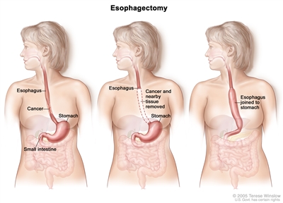Three-panel drawing showing esophageal cancer surgery; first panel shows area of esophagus with cancer, middle panel shows cancer and nearby tissue removed, last panel shows the stomach pulled up and joined to the remaining esophagus.