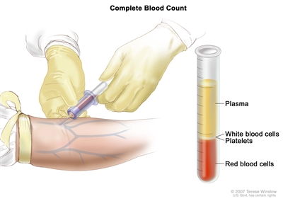 Complete blood count (CBC); left panel shows blood being drawn from a vein on the inside of the elbow using a tube attached to a syringe; right panel shows a laboratory test tube with blood cells separated into layers: plasma, white blood cells, platelets, and red blood cells.