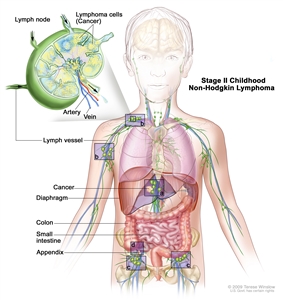 Stage II childhood non-Hodgkin lymphoma; drawing shows cancer in lymph node groups above and below the diaphragm, in the liver, and in the appendix. The colon and small intestine are also shown. An inset shows a lymph node with a lymph vessel, an artery, and a vein. Lymphoma cells containing cancer are shown in the lymph node.