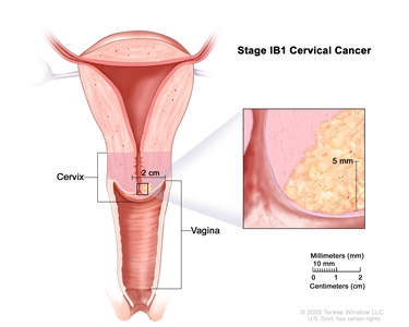 Stage IB1 cervical cancer; drawing shows a cross-section of the cervix and vagina and cancer in the cervix that is smaller than 2 cm. An inset shows cancer that is more than 5 mm deep. Also shown is a 2-cm scale that shows 10 mm is equal to 1 cm.