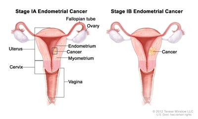 Stage IA and stage IB endometrial cancer shown in two cross-section drawings of the uterus and cervix. Drawing on the left shows stage IA, with cancer in the endometrium and myometrium of the uterus. Drawing on the right shows stage IB, with cancer more than halfway through the myometrium. Also shown are the fallopian tubes, ovaries, and vagina.