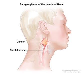 Paraganglioma of the head and neck; drawing shows a tumor near the carotid artery in the head and neck.