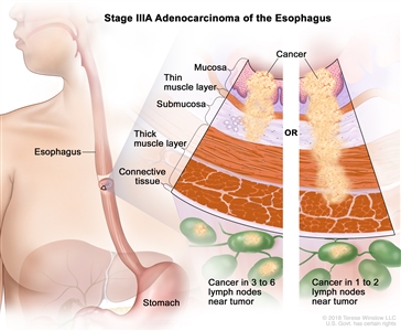 Stage IIIA adenocarcinoma of the esophagus; drawing shows the esophagus and stomach. A two-panel inset shows the layers of the esophagus wall: the mucosa layer, thin muscle layer, submucosa layer, thick muscle layer, and connective tissue layer. The left panel shows cancer in the mucosa layer, thin muscle layer, and submucosa layer and in 3 lymph nodes near the tumor. The right panel shows cancer in the mucosa layer, thin muscle layer, submucosa layer, and thick muscle layer and in 1 lymph node near the tumor.
