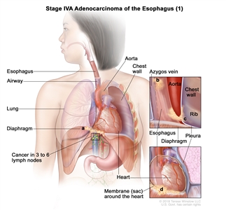 Stage IVA adenocarcinoma of the esophagus (1); drawing shows cancer in the esophagus and in the (a) diaphragm, (b) azygos vein, (c) pleura, and (d) membrane (sac) around the heart. Also shown is cancer in 3 lymph nodes near the tumor. The airway, lung, aorta, chest wall, heart, and rib are also shown.