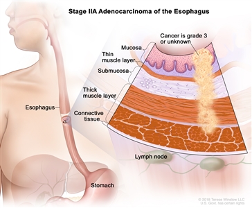 Stage IIA adenocarcinoma of the esophagus; drawing shows the esophagus and stomach. An inset shows cancer cells in the mucosa layer, thin muscle layer, submucosa layer, and thick muscle layer of the esophagus wall. The cancer cells are grade 3 or the grade is not known. Also shown is the connective tissue layer of the esophagus wall and the lymph nodes.