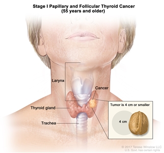 Stage I papillary and follicular thyroid cancer in patients 55 years and older; drawing shows cancer in the thyroid gland and the tumor is 4 centimeters or smaller. An inset shows 4 centimeters is about the size of a walnut. Also shown are the larynx and trachea.