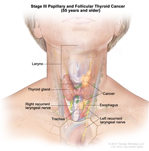 Stage III papillary and follicular thyroid cancer in patients 55 years and older; drawing shows cancer that has spread from the thyroid gland to the esophagus, the trachea, the larynx, and the left recurrent laryngeal nerve. Also shown is the right recurrent laryngeal nerve.