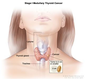 Stage I medullary thyroid cancer; drawing shows cancer in the thyroid gland and the tumor is 2 centimeters or smaller. An inset shows 2 centimeters is about the size of a peanut. Also shown are the larynx and trachea.