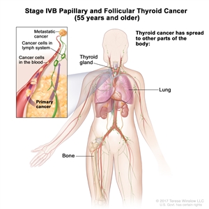 Stage IVB papillary and follicular thyroid cancer in patients 55 years and older; drawing shows other parts of the body where thyroid cancer may spread, including the lung and bone. An inset shows cancer cells spreading from the thyroid, through the blood and lymph system, to another part of the body where metastatic cancer has formed.