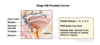 Stage IIIB prostate cancer; drawing shows cancer that has spread from the prostate to the seminal vesicles and to nearby tissue. The PSA can be any level and the Grade Group is 1, 2, 3, or 4. Also shown are the pelvic wall, bladder, and rectum.