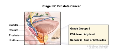 Stage IIIC prostate cancer; drawing shows cancer in one side of the prostate. The PSA can be any level and the Grade Group is 5. Also shown are the bladder, rectum, and urethra.