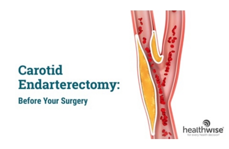 Carotid Endarterectomy: Before Your Surgery