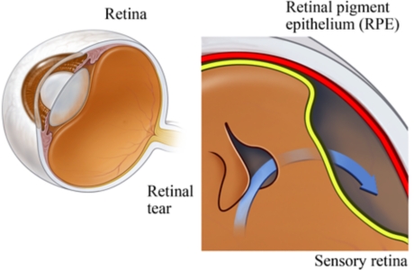 A detached retina
