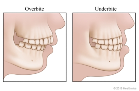 Skeletal views of overbite and underbite