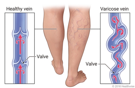 External view of legs with and without varicose veins, with details of healthy vein and twising varicose veins