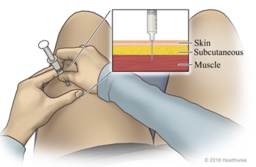 Needle through skin with detail of needle going through subcutaneous tissue to muscle.
