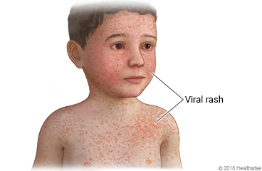 A viral rash on the face and chest of a child