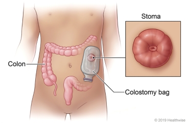Location of colon in the body, with colostomy bag placed over a stoma and closeup view of a stoma.
