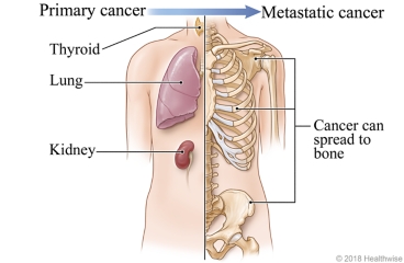 Primary cancer in the thyroid, lung, kidney, or other organ can move to bone and become metastatic cancer.