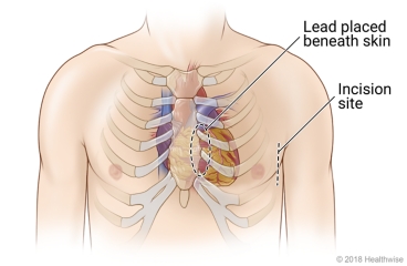Location in the chest where a subcutaneous ICD is placed under the skin