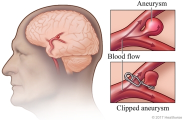 Before and after surgery to repair an aneurysm with a clip