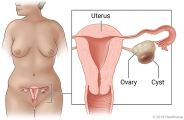 Female pelvic organs in lower belly, with detail of uterus, ovary to side of uterus, and cyst on ovary