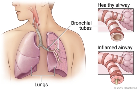 Lungs in chest showing bronchial tubes in left lung, with detail of healthy airway and airway inflamed by bronchitis