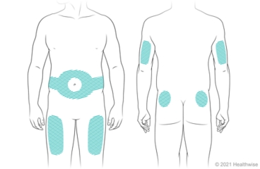 Locations on body for giving insulin shots, including belly at least 2 in. from navel, front of thighs, back of upper arms, and upper buttocks.