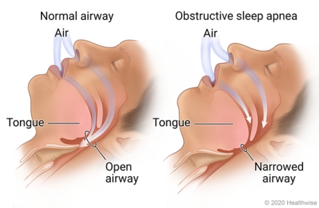 Normal airway, showing air flowing through open airway, compared to obstructive sleep apnea, showing air flow blocked by tongue in narrowed airway.