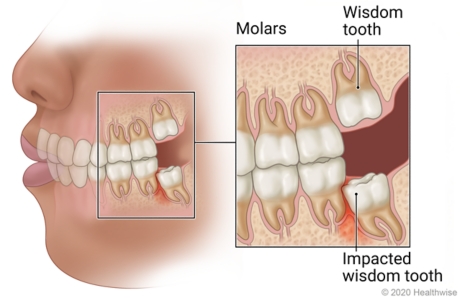 Wisdom teeth in back of left side of mouth, with close-up of six molars including wisdom tooth under gum and impacted wisdom tooth causing inflamed tissue.