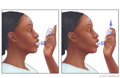 Person placing inhaler close to open mouth and pressing down on inhaler as they breathe in.