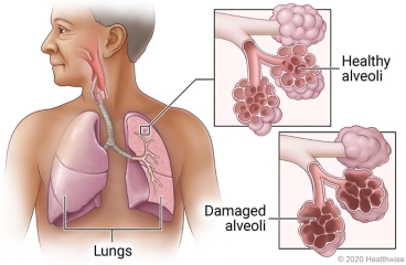 Lungs in chest, showing airways of a lung with detail of healthy alveoli and damaged alveoli