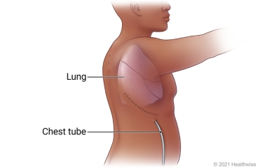 Side view of person, showing lung in chest and placement of chest tube at side.