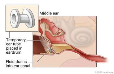 Temporary ear tube inserted in eardrum, showing fluid from middle ear draining into ear canal.