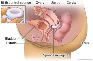 Female pelvic organs, showing ovary, uterus, cervix, bladder, clitoris, and anus, with birth control sponge placed in vagina at cervix.