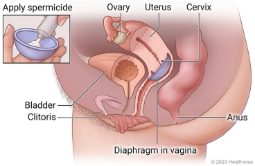 Female pelvic organs, showing ovary, uterus, cervix, bladder, clitoris, and anus, with spermicide put in diaphragm and placed in vagina at cervix.