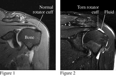 MRI images of torn rotator cuff