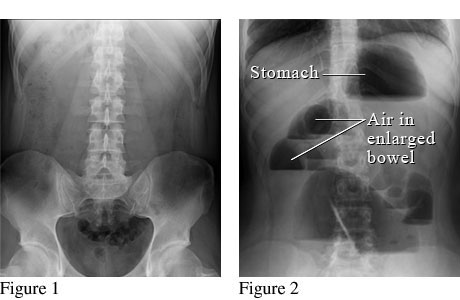 Abdominal X-ray of a bowel obstruction.