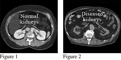 CT scan showing normal kidneys and damaged kidneys