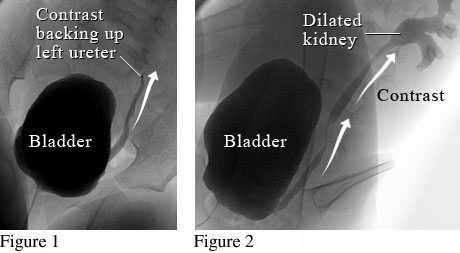 Cystourethrogram of bladder