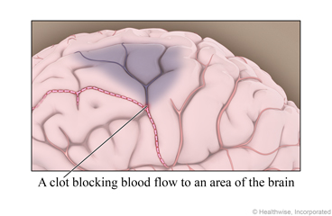 A clot blocking blood flow to an area of the brain