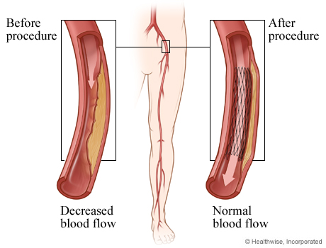 Decreased blood flow before angioplasty and normal blood flow after angioplasty