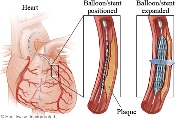 Coronary artery with a stent