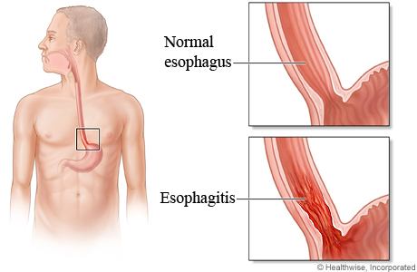 Normal esophagus compared to one with esophagitis
