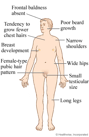 Male with Klinefelter syndrome